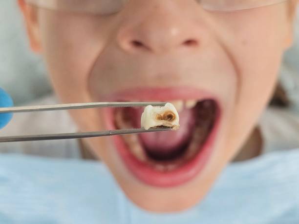 Best Emergency Wisdom Teeth Removal in Gouldtown, NJ
